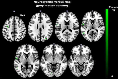 Neurosyphilis Mri