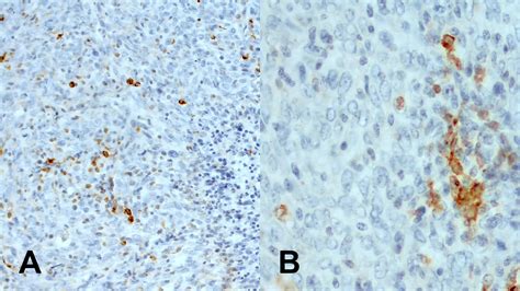 CD11c - more than a marker for dendritic cells in histopathology