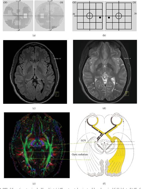 Figure 1 From Diffusion Tensor Imaging For In Vivo Detection Of