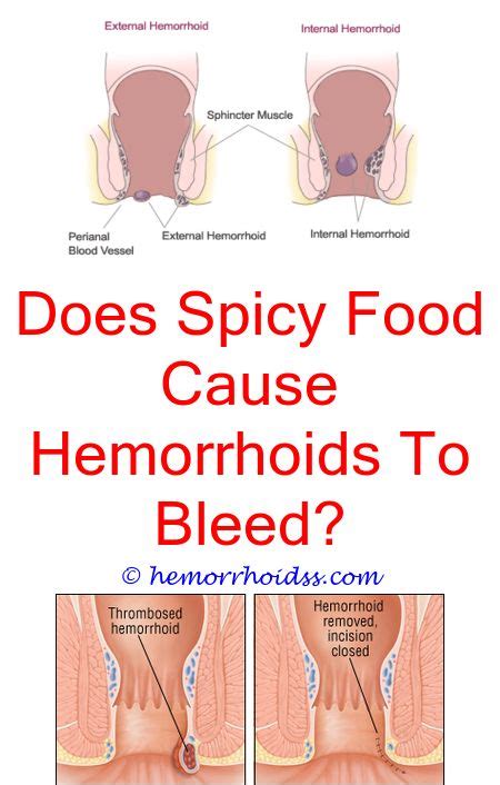 How To Cure Hemorrhoids At Home Quickly Bleeding Hemorrhoids