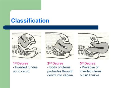 Inversion Of The Uterus