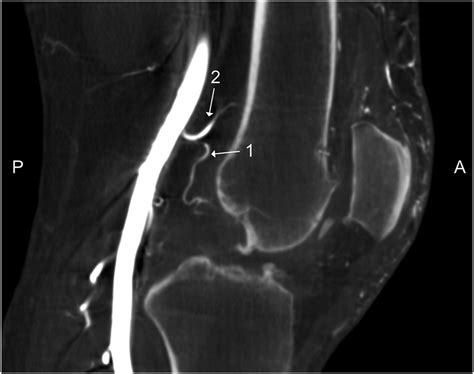 Genicular Artery Embolization A Review Of Essential Anatomic