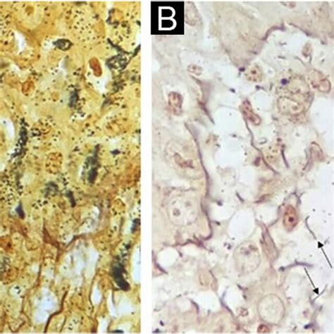 A Basal Cell Layer Background Staining Warthin Starry Staining