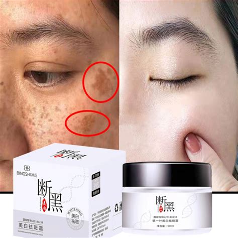 Effective Freckle Removal Whitening Cream Melasma Removal Cream Original Set Pekas Remover Serum