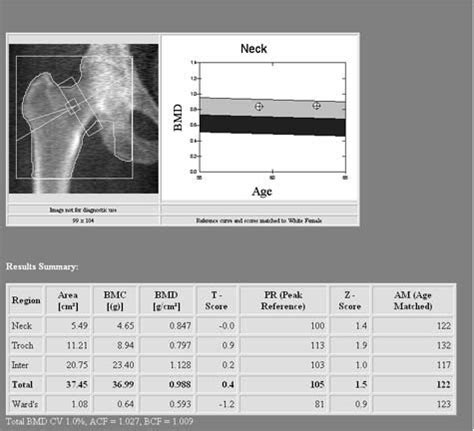 Bone Density Scan In Breckenridge Mn Chi St Francis Health