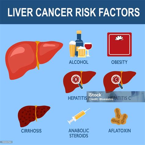 Liver Cancer Risk Factors Infographic Vector Illustration Stock Illustration Download Image