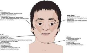 Treacher Collins Syndrome - Physiopedia