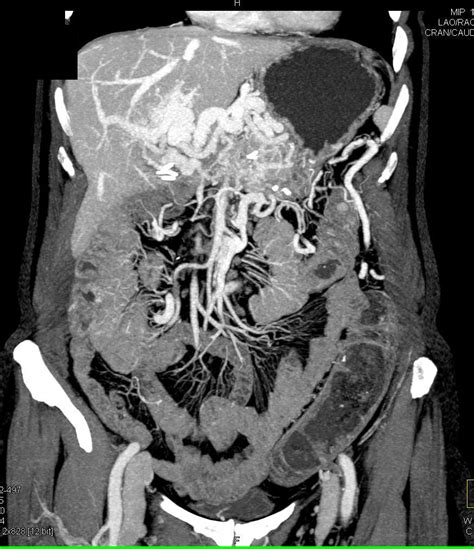 Angiodysplasia Of The Colon As Related To Sulfasalazine Pictures