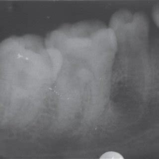 Iopa Radiograph Pre Op Showing Blunderbuss Apex And Large Periapical