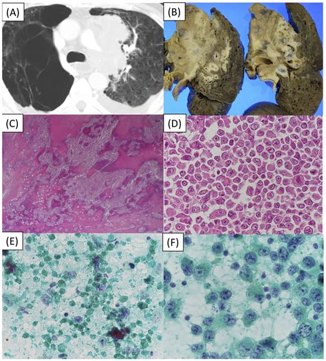 Cytopathological Features Of Smarca4 Deficient Thoracic Sarcoma Report Of 2 Cases And Review Of