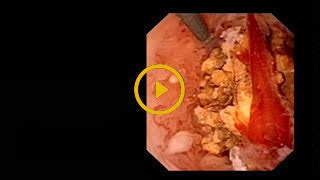 Narrow Band Imaging Nbi In Urologie