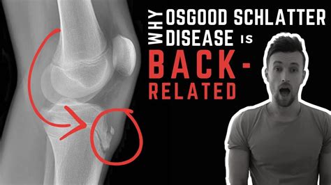 Osgood schlatter disease – Artofit