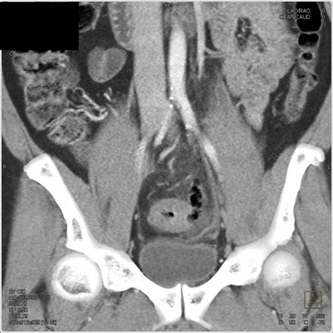 Diverticulitis With Focal Perforation Colon Case Studies Ctisus Ct