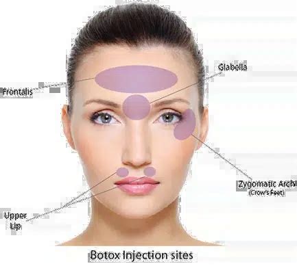 Aging Gracefully With Botox Tips For Maintaining Natural Looking Results