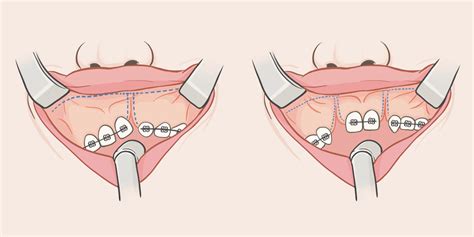 Schematic Diagram Demonstrating Soft Tissue Incision Of Download