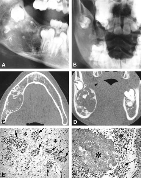 Combined Benign Odontogenic Tumors Ct And Mr Findings And