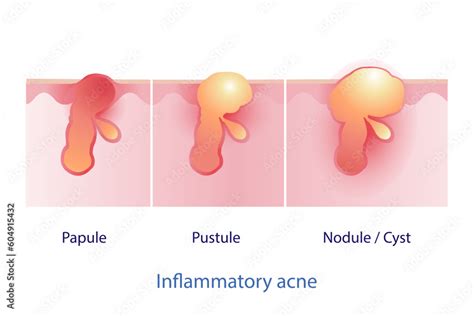 Vecteur Stock Types Of Inflammatory Acne Vector On White Background