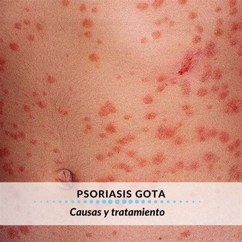 Psoriasis En Gota Causas Y S Ntomas Blue Cap