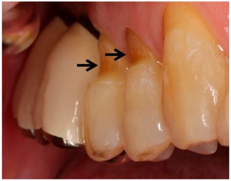 Abfraction Causes Nccl Causes Nccl Treatment Bauer Smiles 45 Off