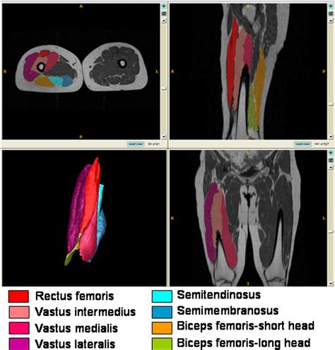 Figure 2 from Mri-based 3d Shape Analysis of Thigh Muscles: Patients with Chronic Obstructive ...