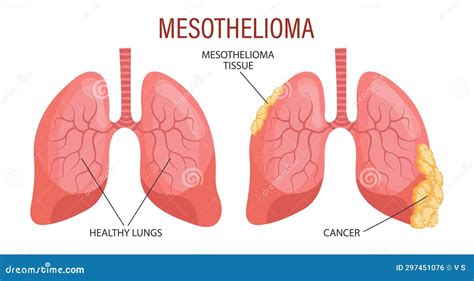 Stages Of Mesothelioma Lung Disease Healthcare Stock Illustration