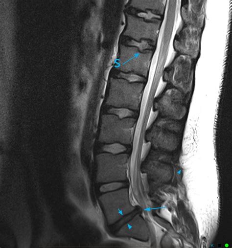 Mri Spine Paediatic Mri Series