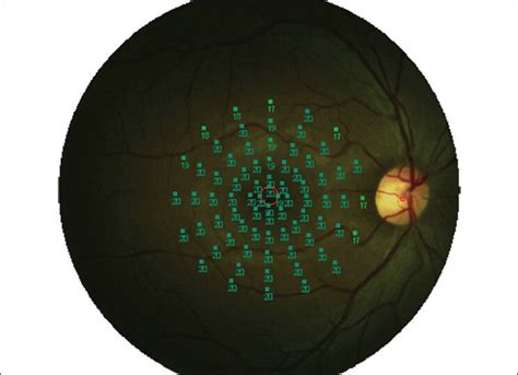 MP1 Fundus Perimetry Study Protocol Performed In The Central 20 With