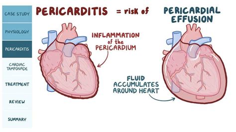 Pericardial Disease Pathology Review Video Causes And Meaning Osmosis