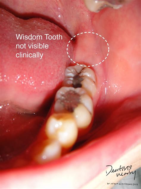 Signs That Wisdom Teeth Are Coming Through Teethwalls