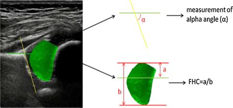 The α angle and FHC of DDH in an ultrasound image | Download Scientific ...