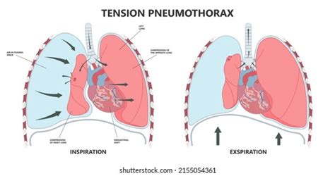 Lung Surgery For Collapsed Lung