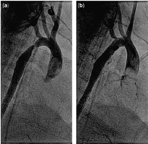 Aortography In The Right Lateral Projection Presenting Coarctation Of