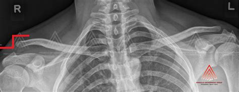 Acromioclavicular Joint Dislocation X Ray 51824 Hot Sex Picture