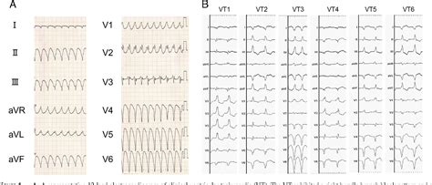 Figure From Pathology After Combined Epicardial And Endocardial