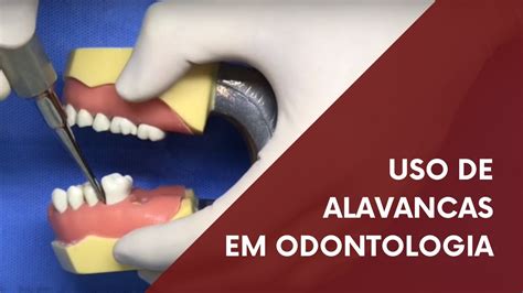 Uso De Alavancas Em Odontologia YouTube