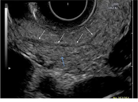 Normal Endoscopic Ultrasound Image Of The Pancreatic Body Acquired With Download Scientific