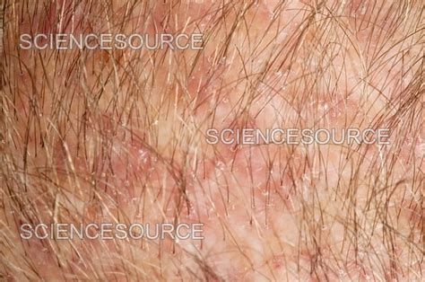 Folliculitis Of The Scalp Stock Image Science Source Images