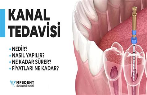 Kanal Tedavisi Nedir Endodonti Kanal Tedavisi Fiyatları