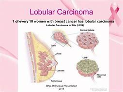 lobular carcinoma - HOW TO STAY HEALTHY FOR LIFE