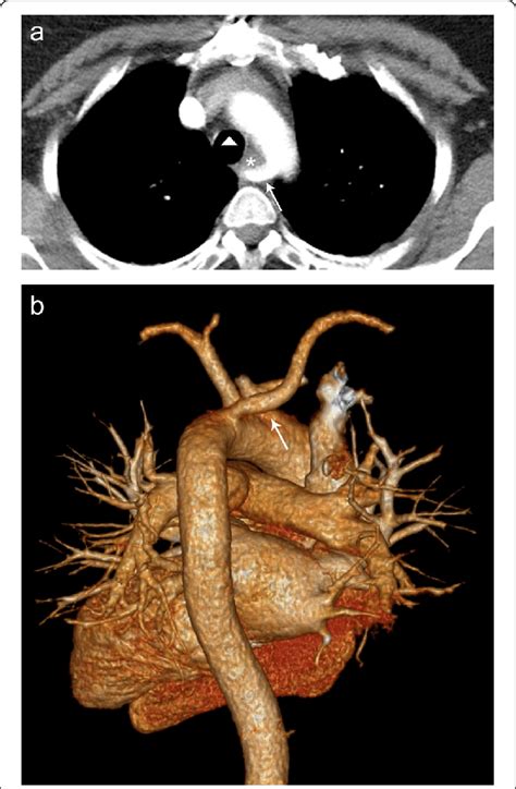 Aberrant Right Subclavian Artery Axial A Ct Image Demonstrating Download Scientific Diagram