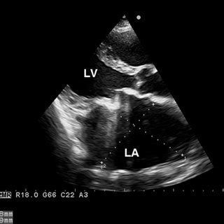 Transthoracic Echocardiogram Parasternal Short Axis View Of The Left