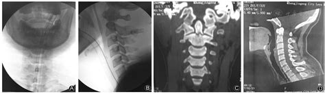 Odontoid Fracture X Ray