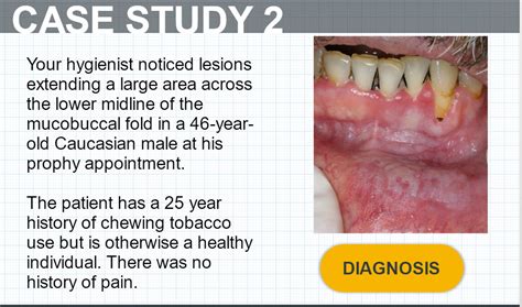 Smokeless Tobacco Oral Lesions