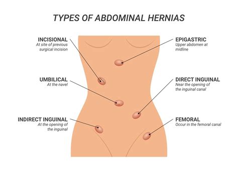 Types Of Abdominal Hernias Illustration On Isolated Background 9571989