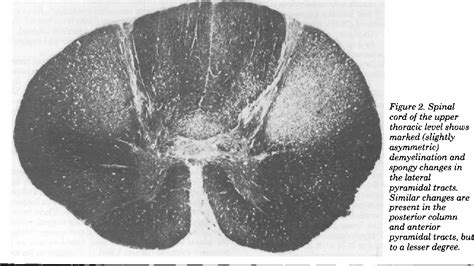 Figure 2 From Spinal Cord Degeneration In Aids Semantic Scholar