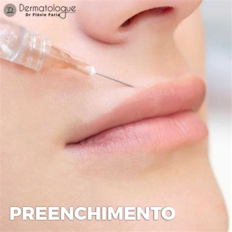 Preenchimento O Preenchimento Facial Um Dos Procedimentos Mais