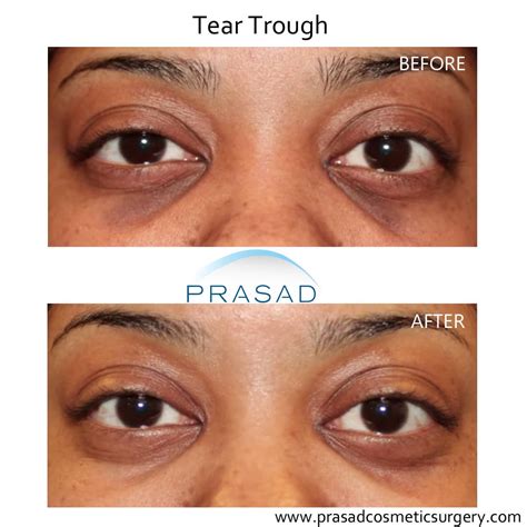 Under Eye Filler Before And After Photos Prasad Cosmetic Surgery Ny