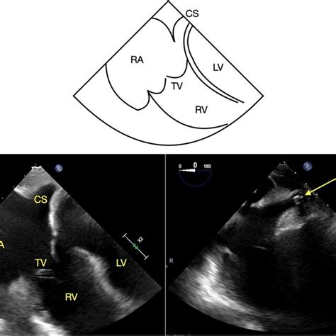 Modified Bicaval View Of The Coronary Sinus With And Without A Coronary