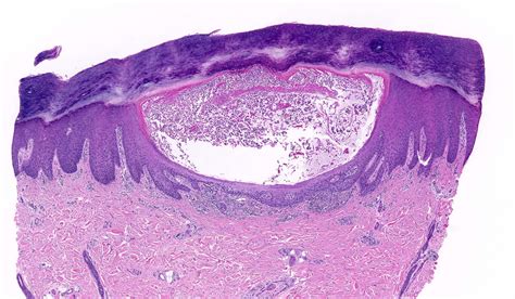 Guttate Psoriasis Histology