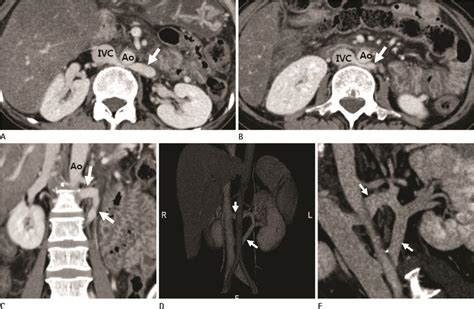 Multi Detector Ct Findings Of Double Retroaortic Left Renal Veins